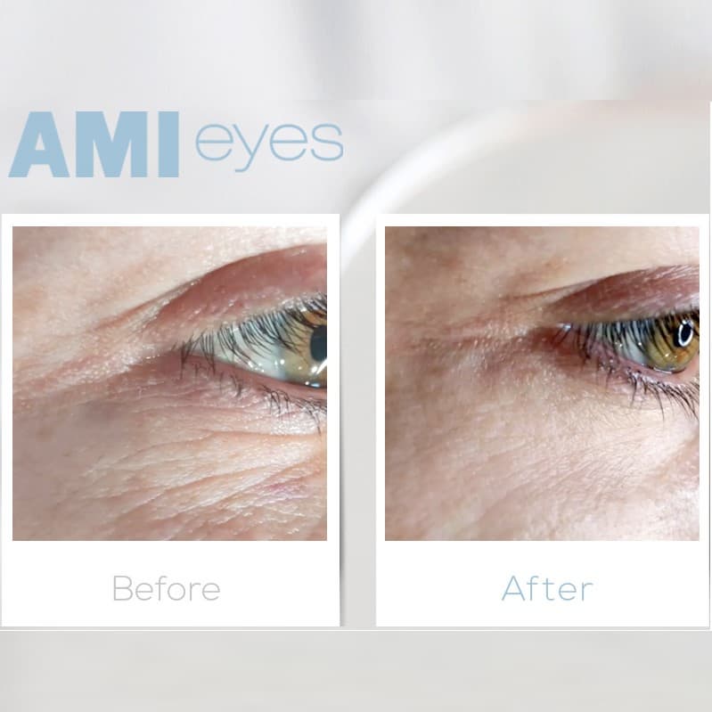 AMI Eyes
