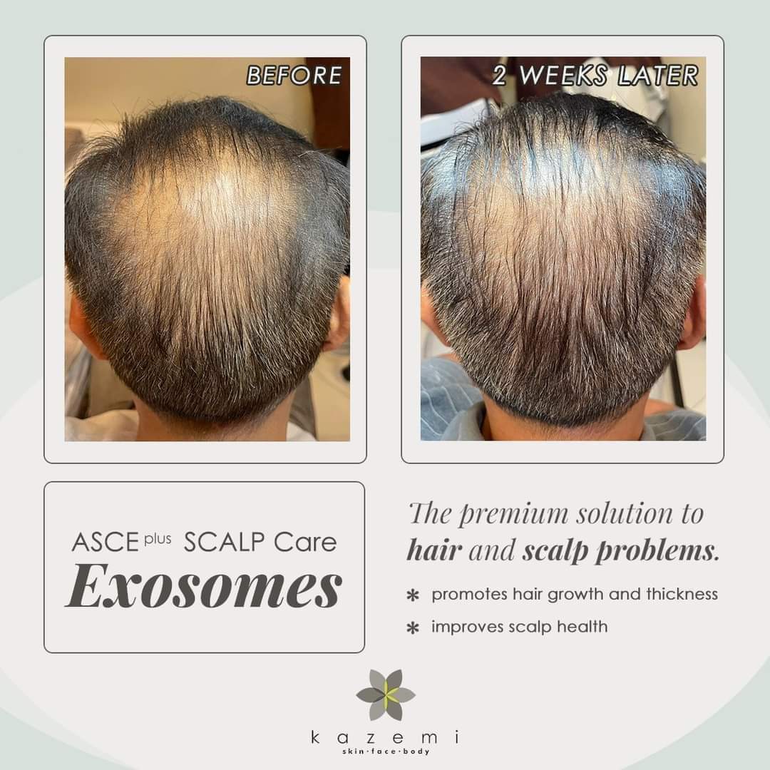 ASCE Scalp Hair HRLV | Exosomes