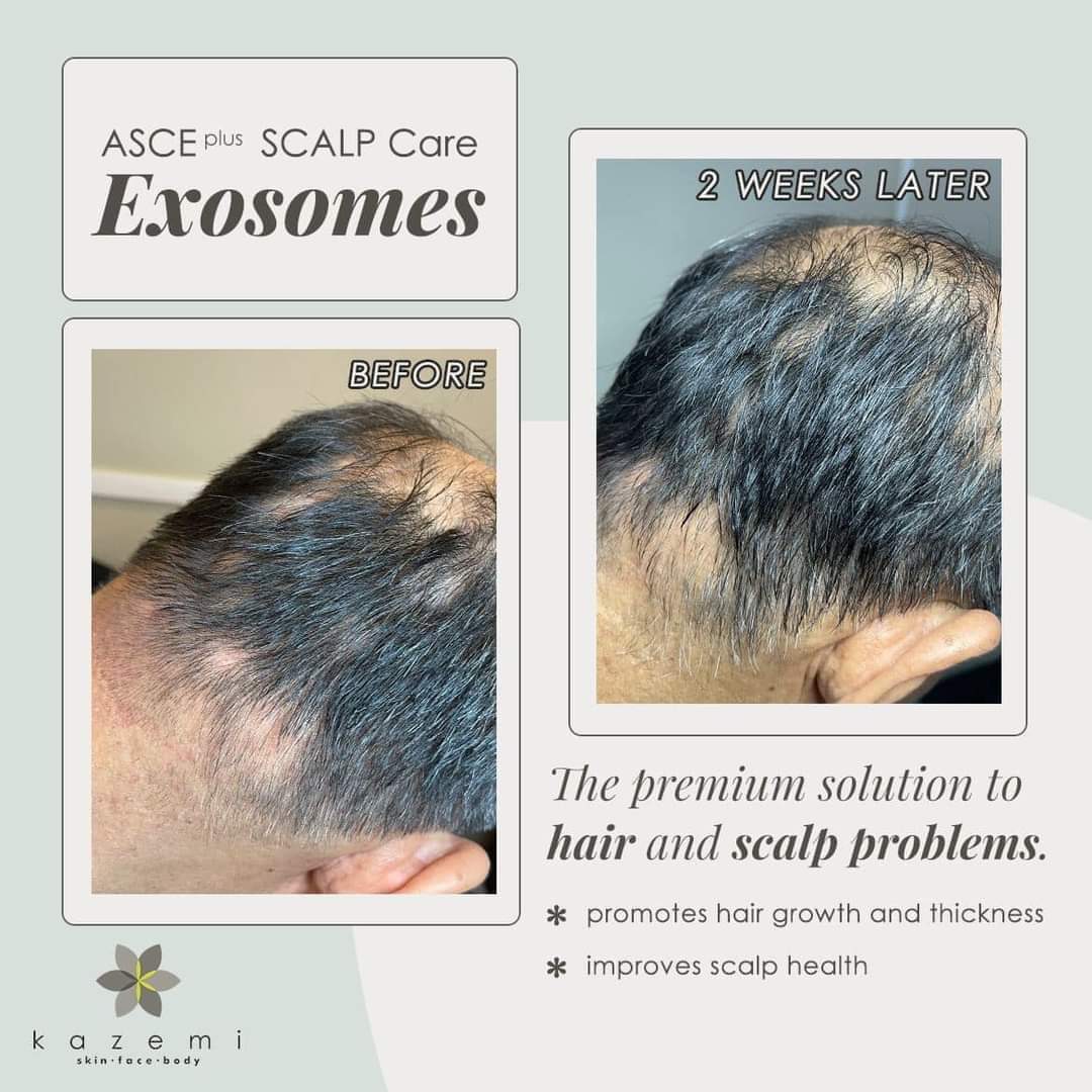 ASCE Scalp Hair HRLV | Exosomes