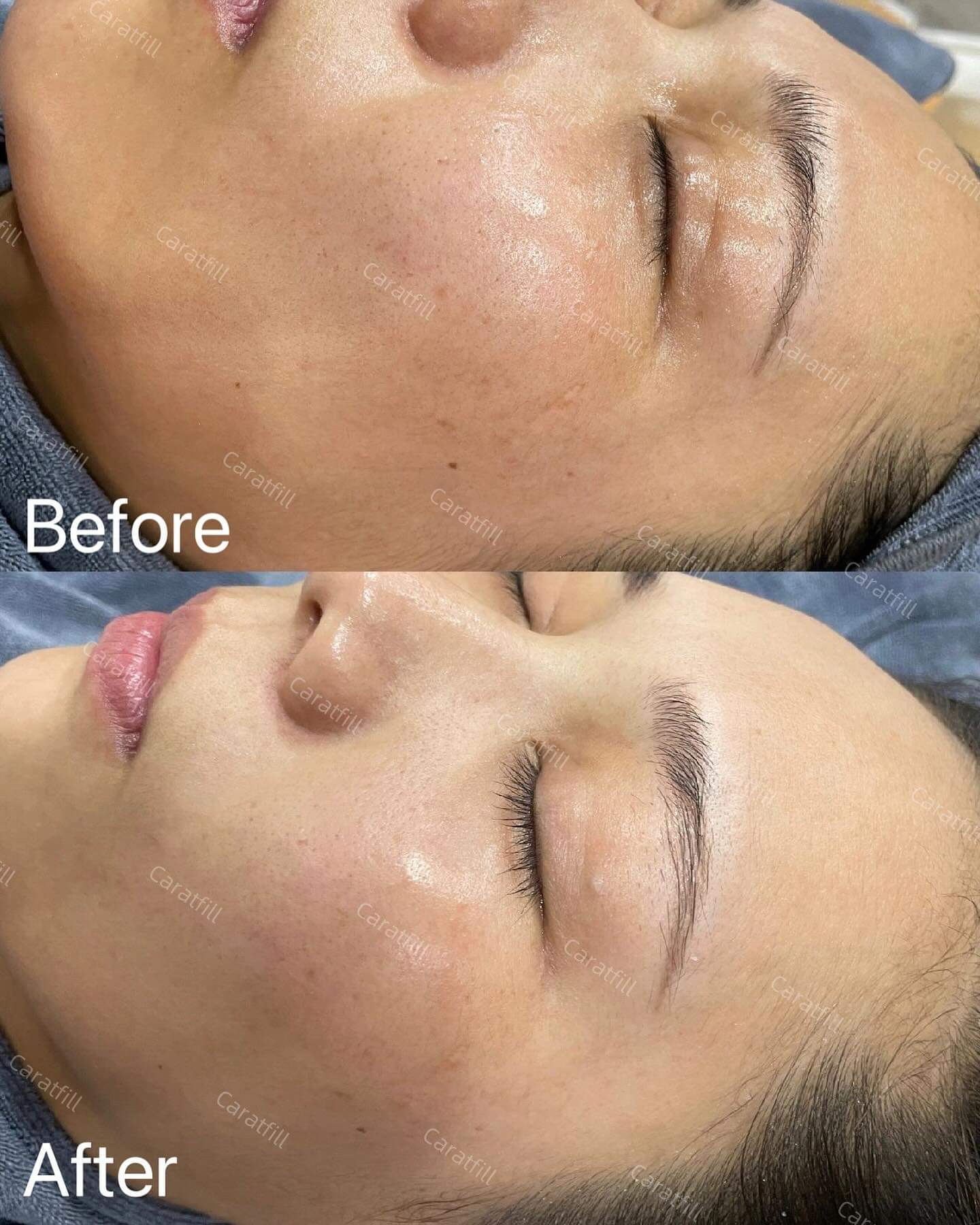 Caratfill™ Youthful Essence Skin Booster