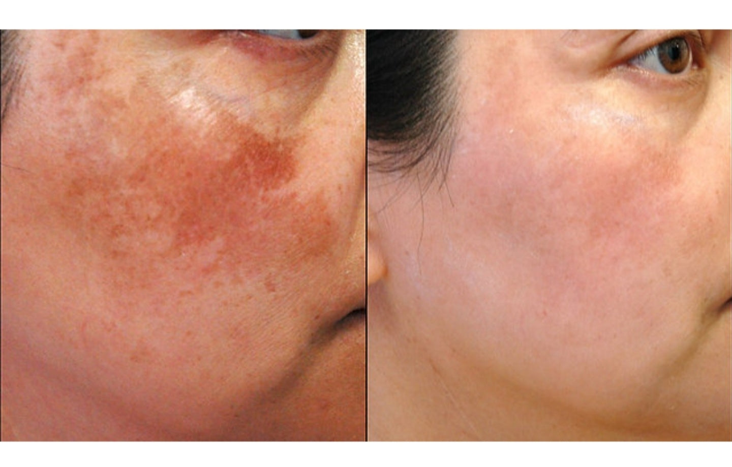 Nuova versione Transmin Melasma 500mg Sbiancante per la pelle Giapponeトランサミン肝斑治療