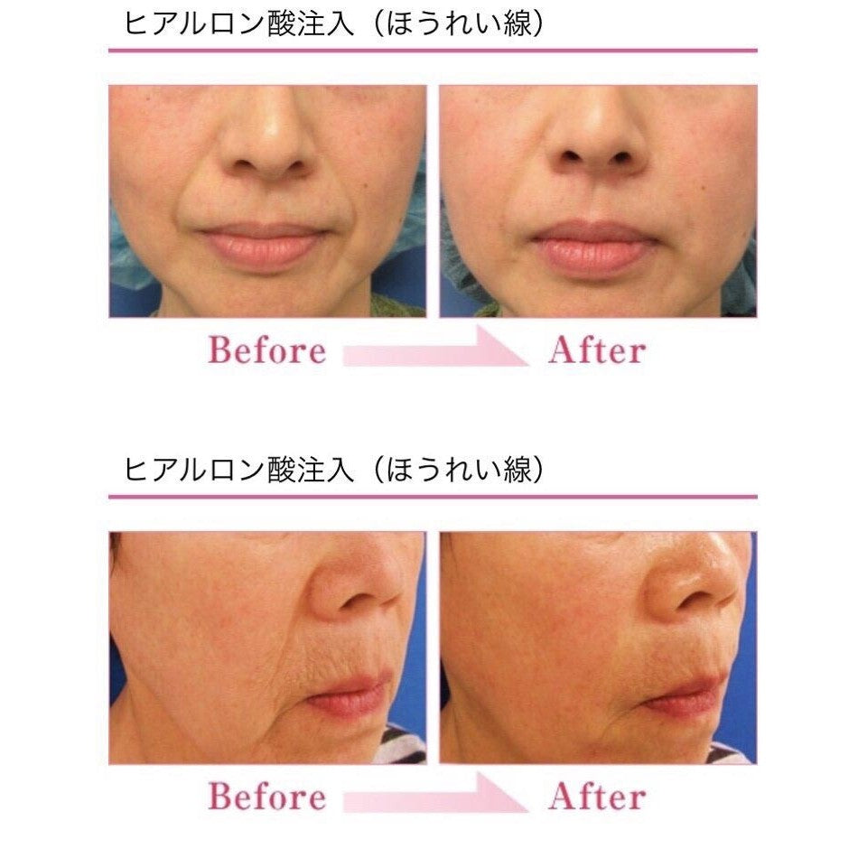 Japanese Hyaron | TEVA Japan Skin Rejuvenating Super Moisturizing Hyaluronic Acid Serum for Joints & Facial ヒアルロン酸Na関節注25mg「日新」| Japan Hyaront