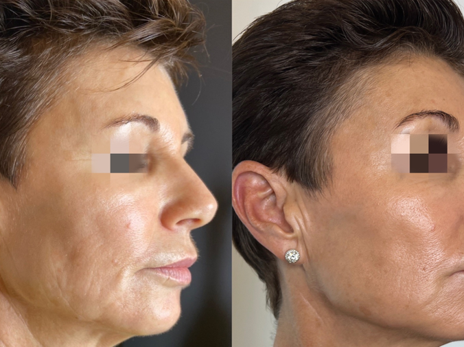 GOURI PCL | Alternative to Profhilo