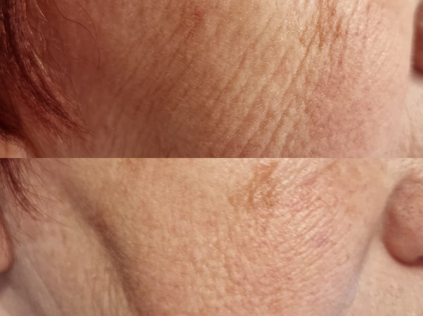 GOURI PCL | Alternative to Profhilo