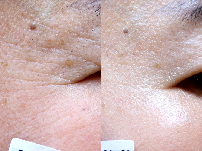 GOURI PCL | Alternative to Profhilo