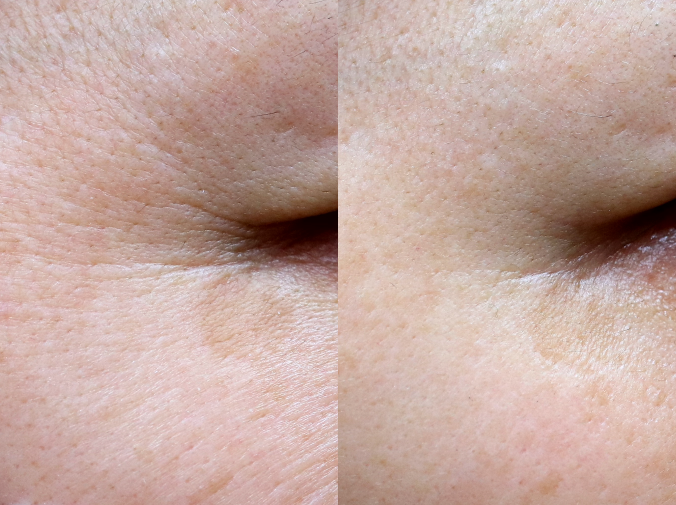 GOURI PCL | Alternative to Profhilo